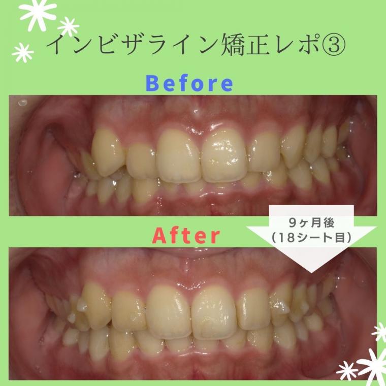 ❁　八重歯の歯科矯正にインビザライン