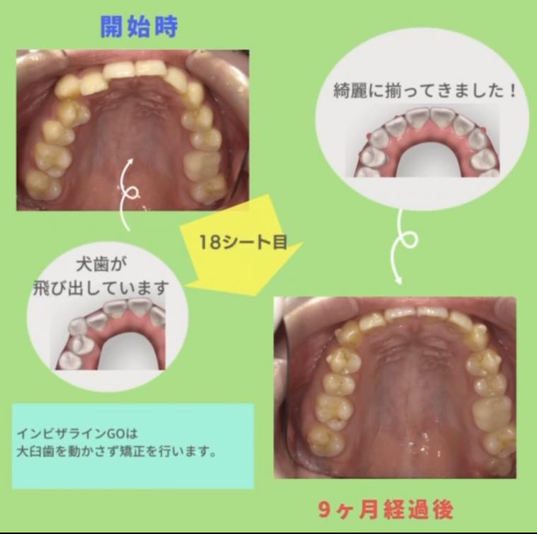 ❁　八重歯の歯科矯正にインビザライン