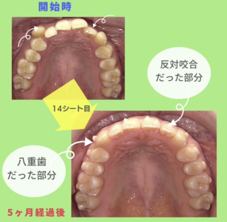 ❁　ノンブラケット矯正『インビザライン』はじめました。