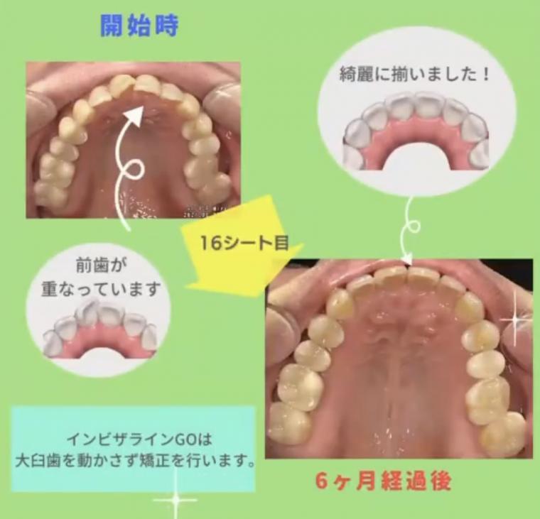 ❁　軽度な歯列矯正なら『インビザラインGO』　