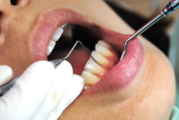Step02 歯周精密検査