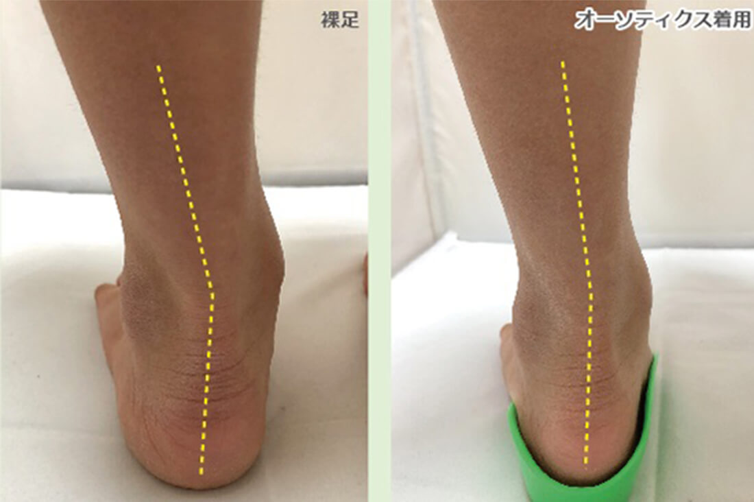 体の歪みを補正するフットオーソティクス