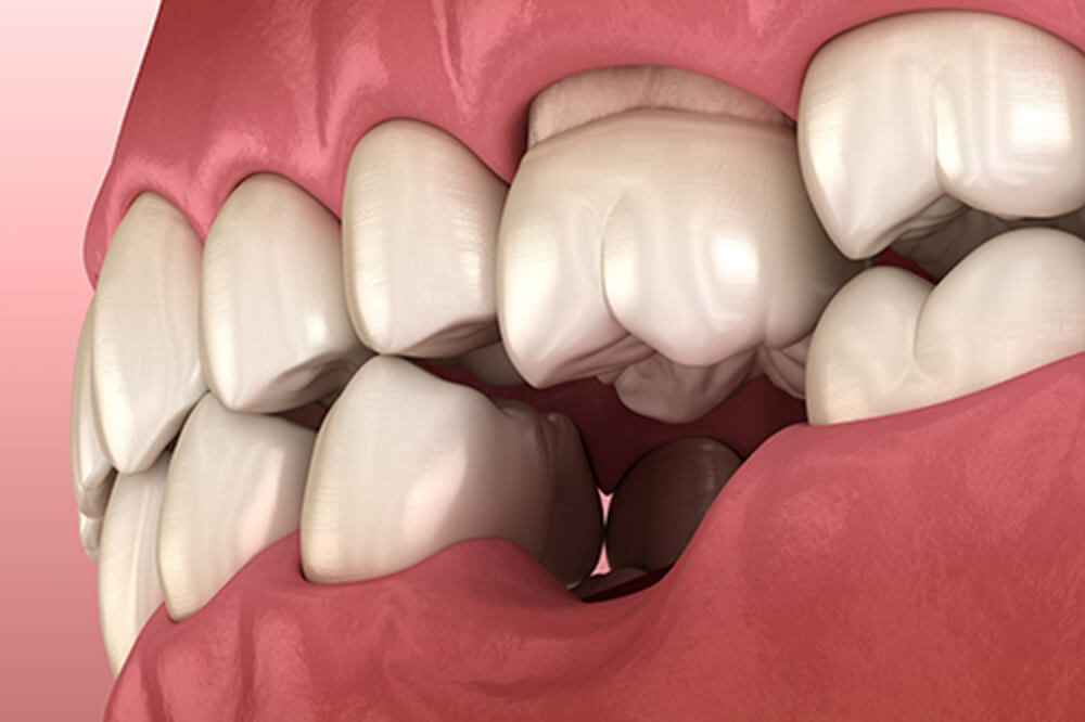 歯の欠損による機能不全