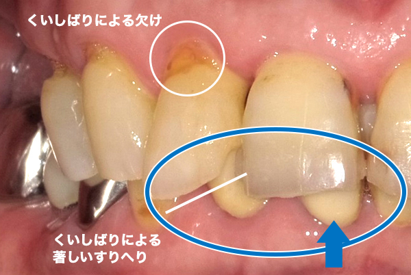 咬合療法2 咬み合わせ調整前01-01