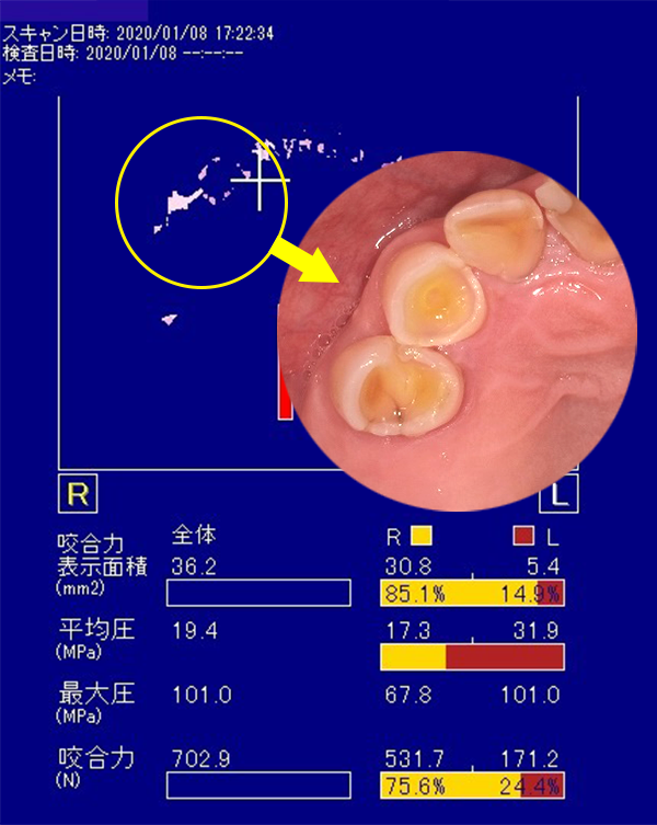 咬合療法2 咬み合わせ調整前02-01