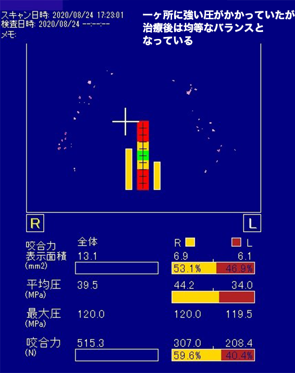 咬合療法2 治療終了時02-02