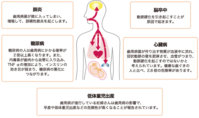 口腔内が不衛生だと全身に影響を及ぼします